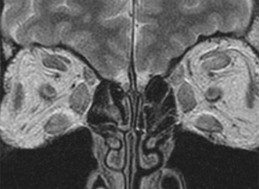 頭部MRI甲状腺眼症